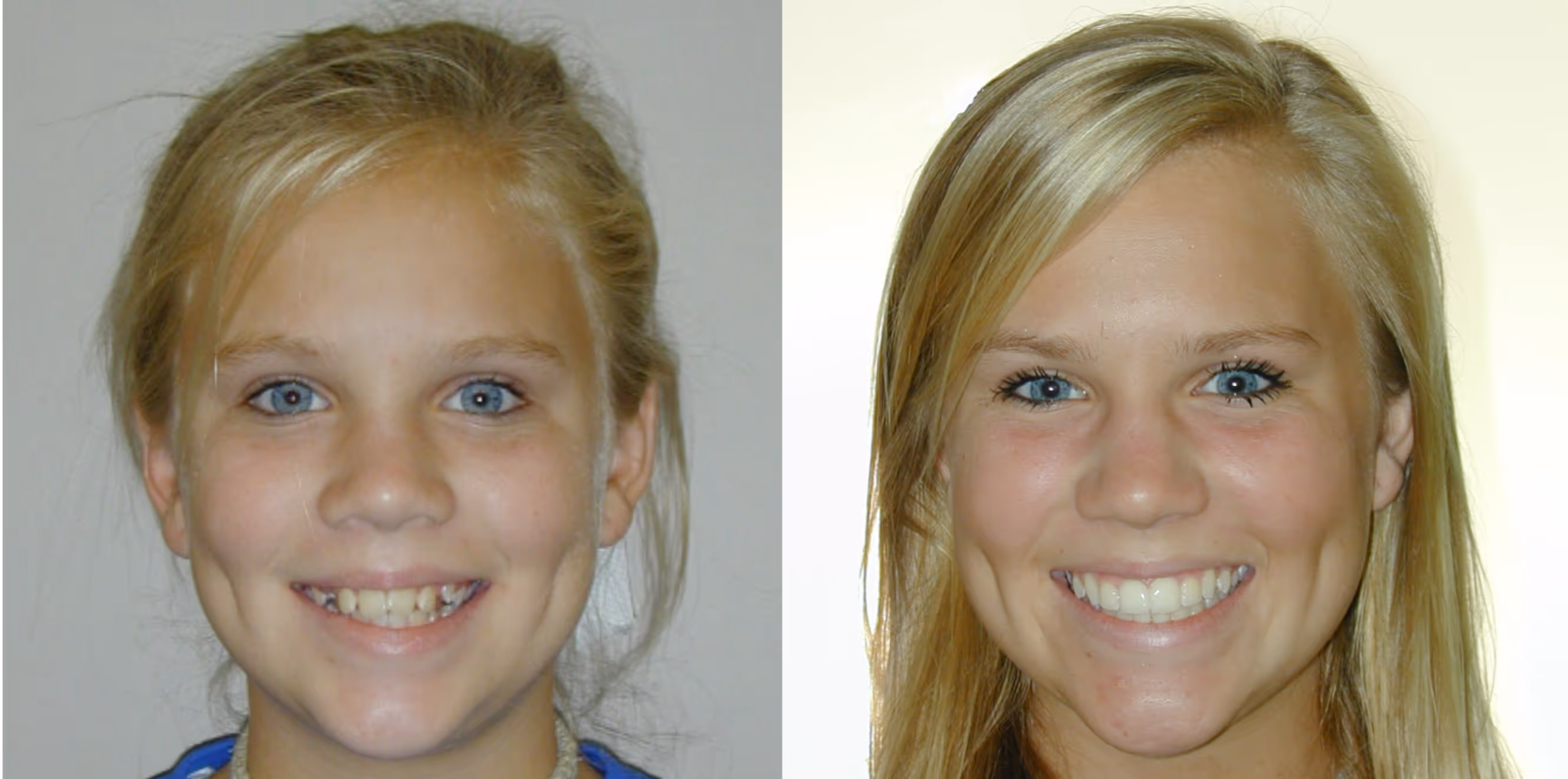 Orthodontic smile gallery transformation 1