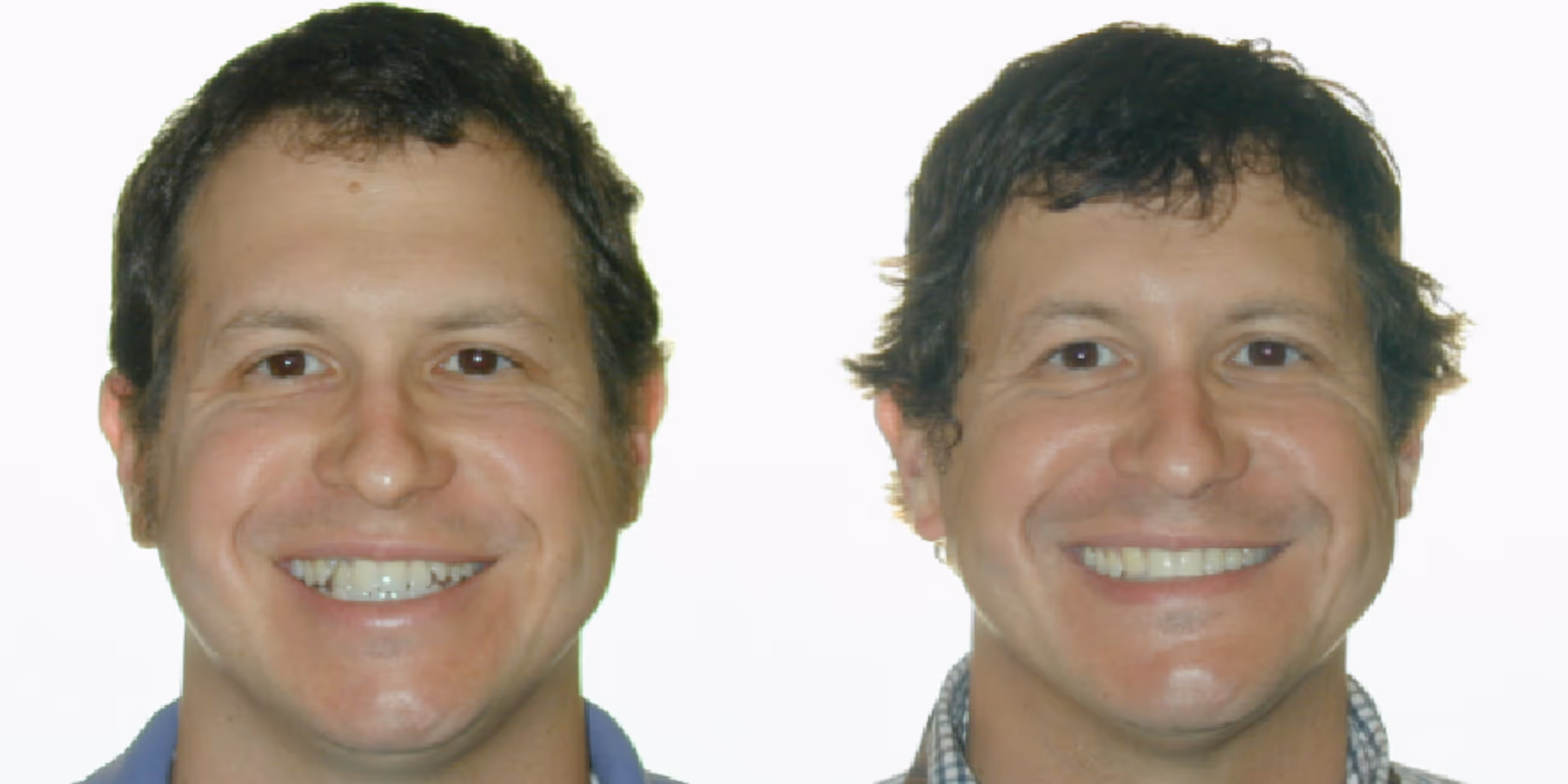 Orthodontic smile gallery transformation 2