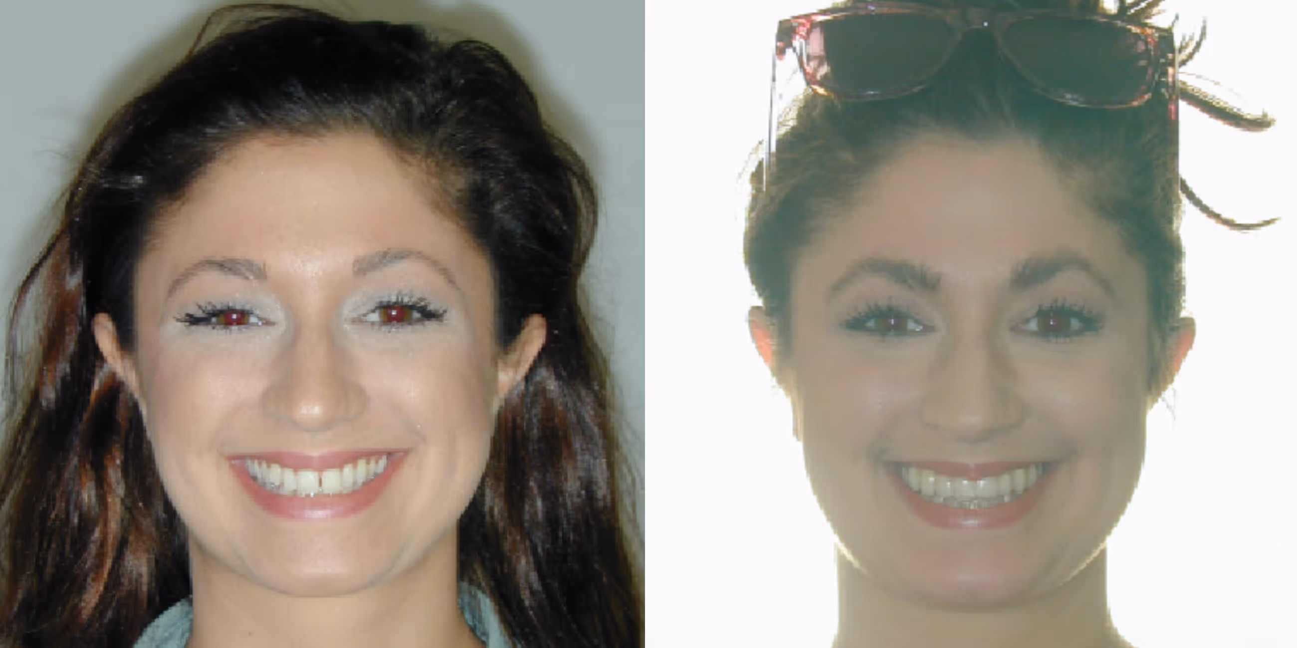 Orthodontic smile gallery transformation 3