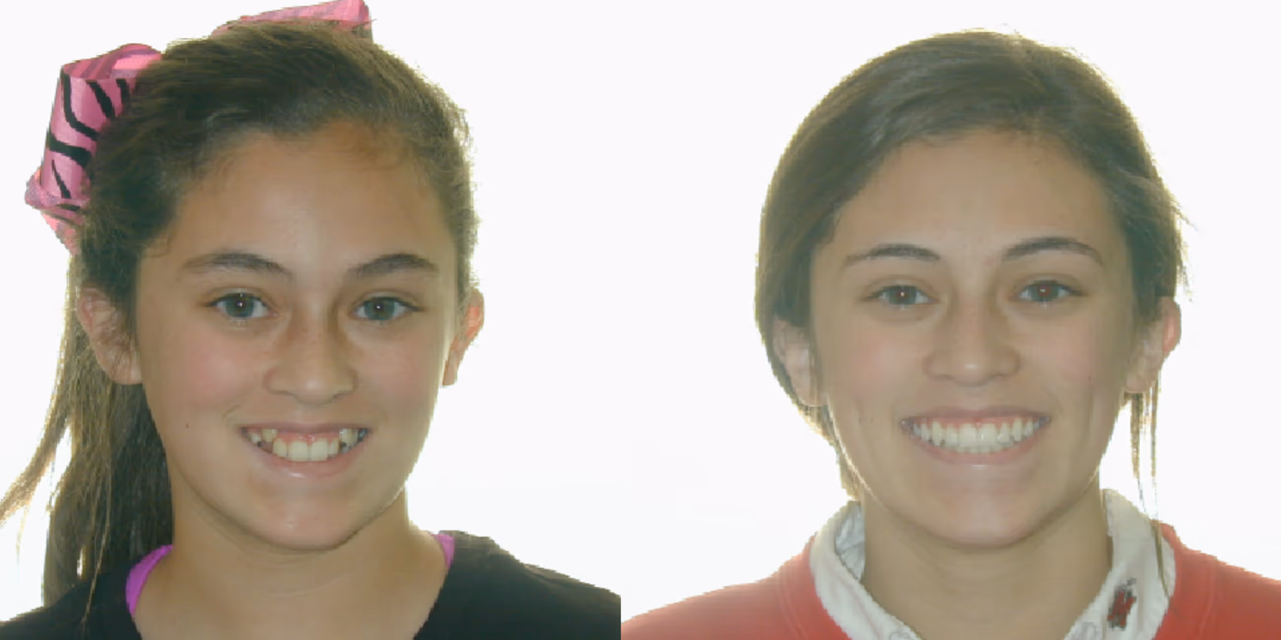 Orthodontic smile gallery transformation 4
