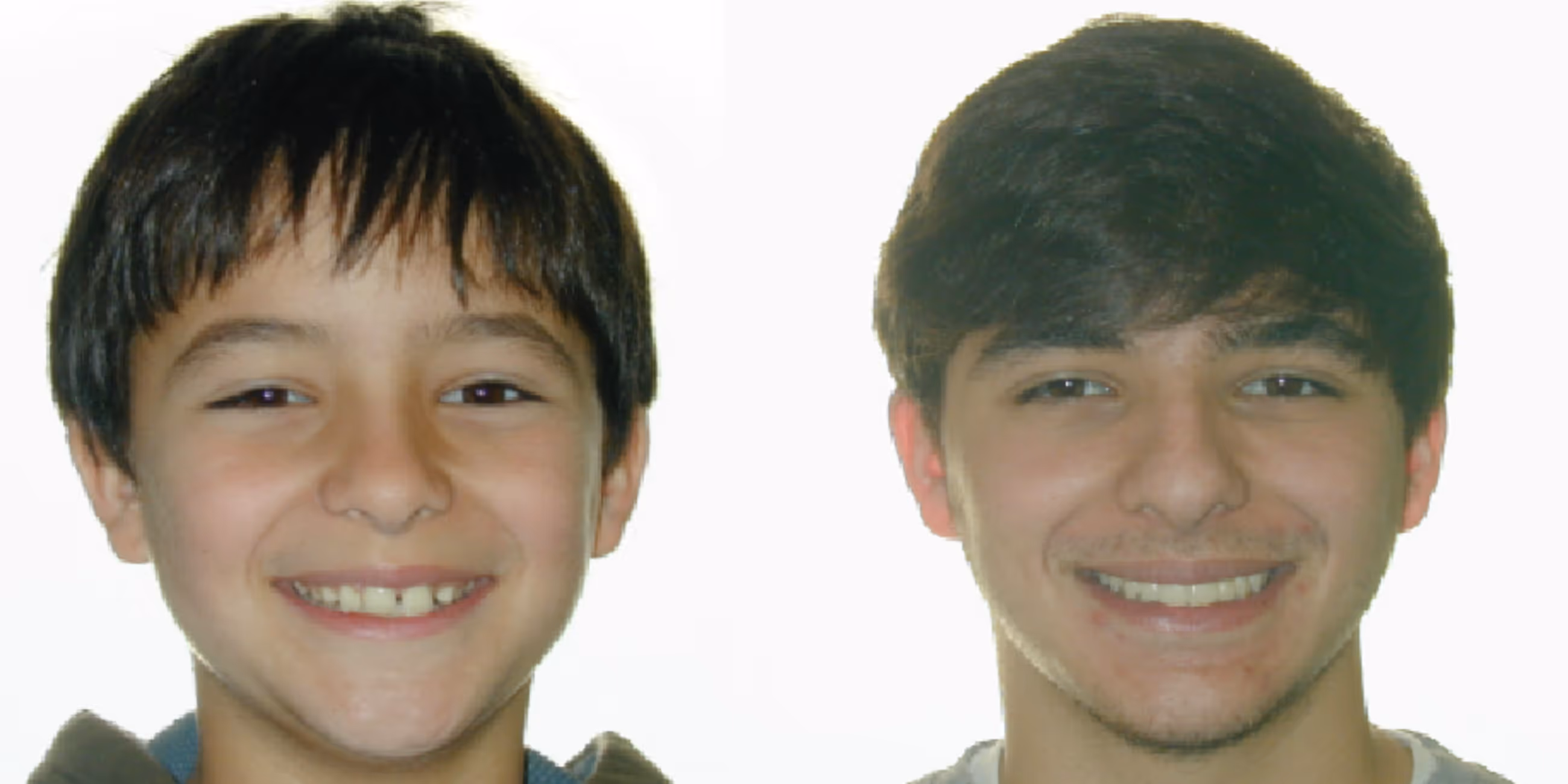 Orthodontic smile gallery transformation 5