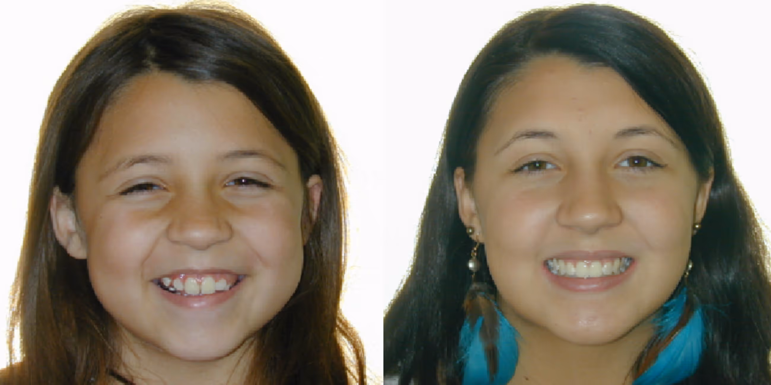Orthodontic smile gallery transformation 6