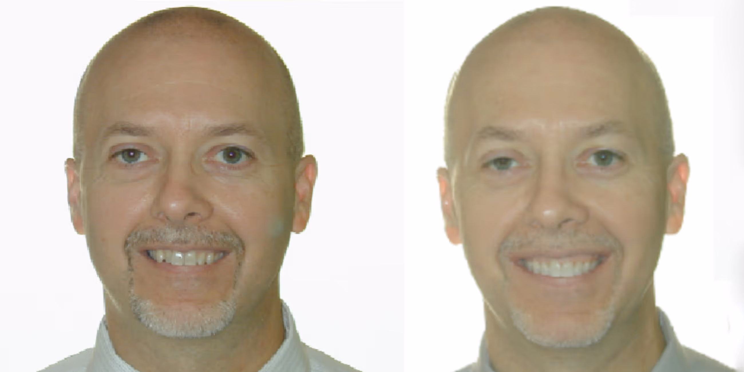 Orthodontic smile gallery transformation 7