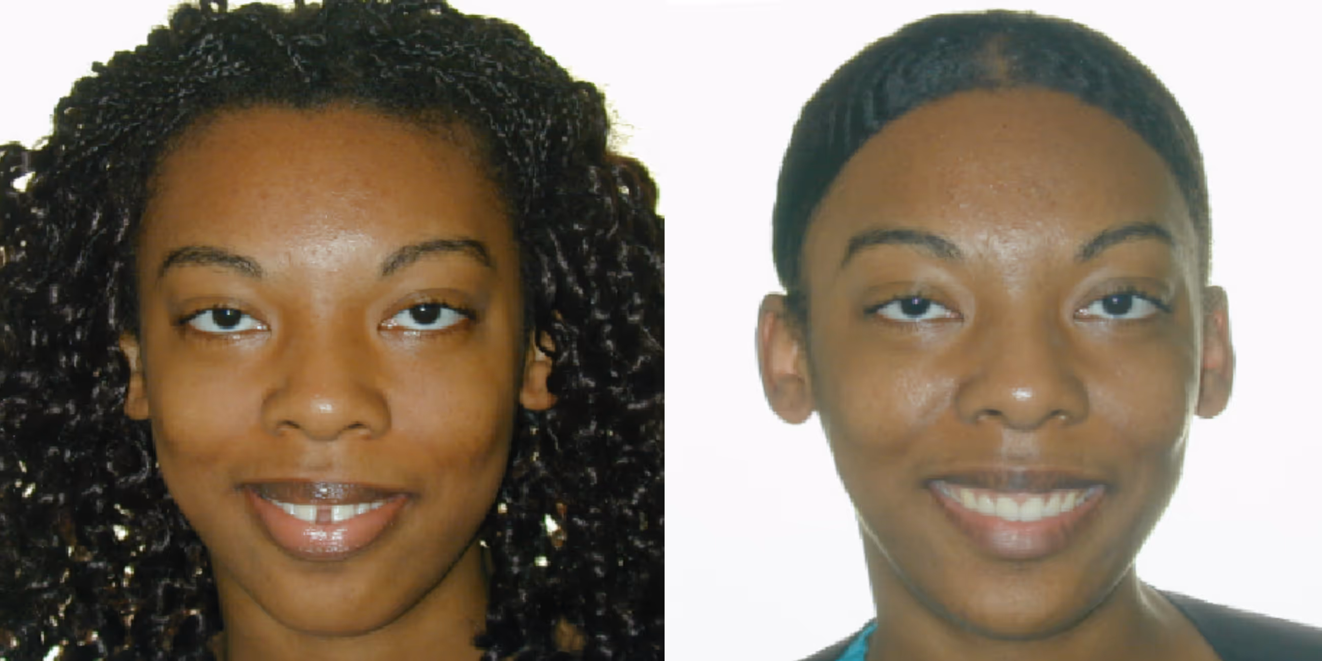 Orthodontic smile gallery transformation 8