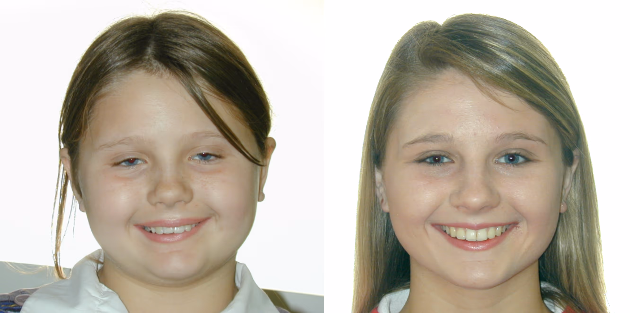 Orthodontic smile gallery transformation 9