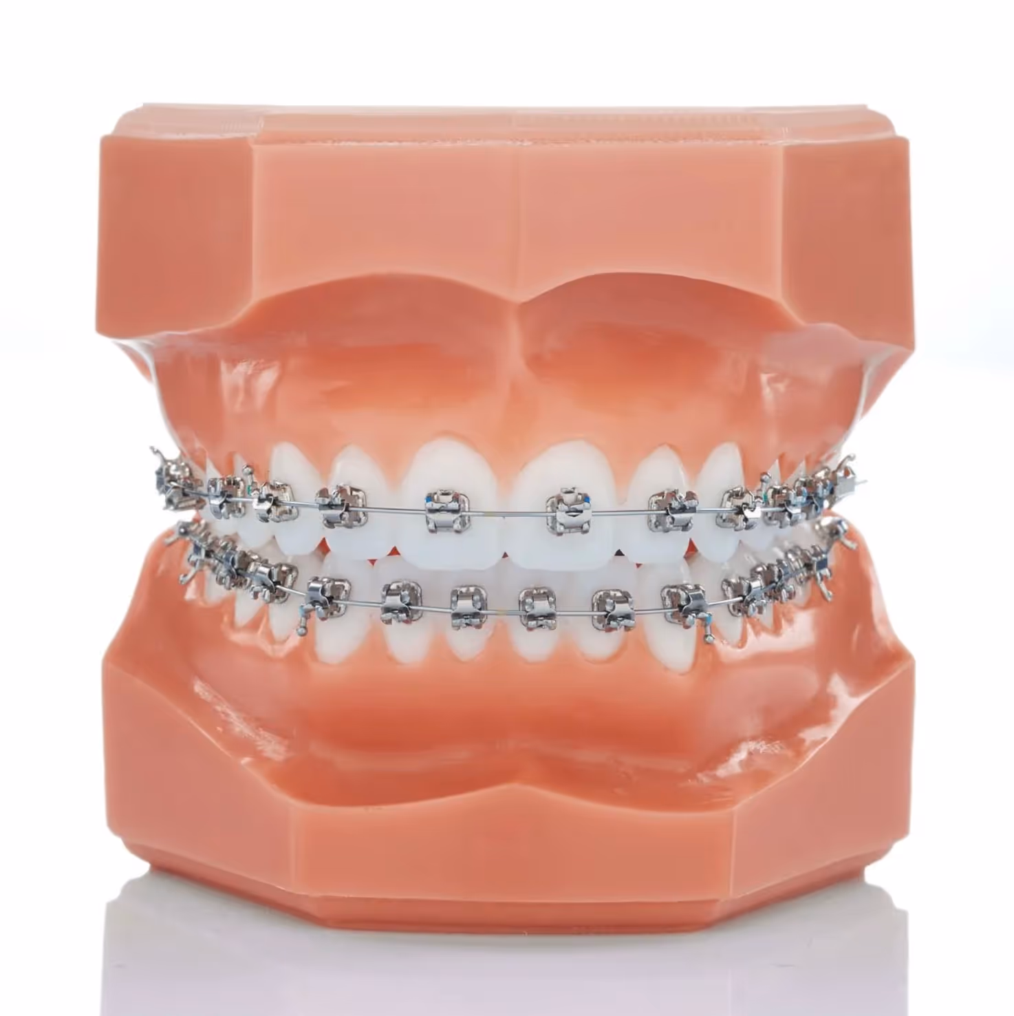 Teenager with Metal Braces smiling